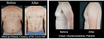 slimlipo male patient before and after
